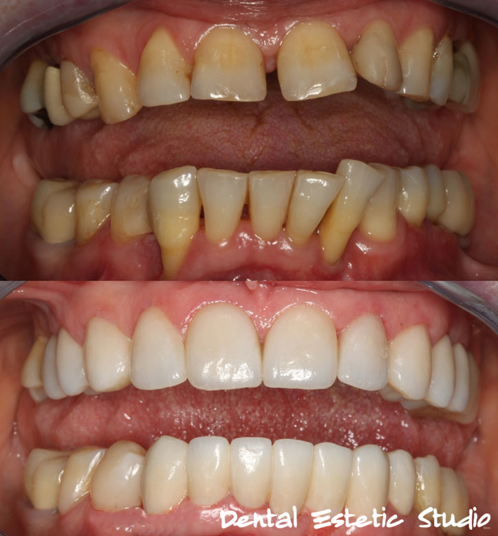 Kombinacija porculanskih ljuskica ,bezmetalnih navlaka i mostova