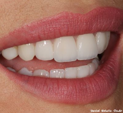 LJUSKICE - FAZE IZRADA