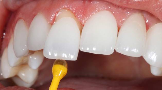 ljuskica na štapiću